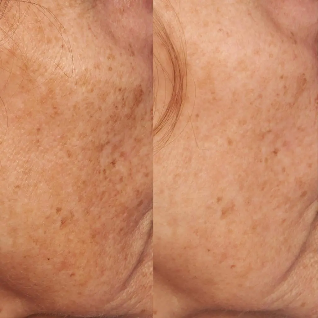 Perricone MD Vitamin C Ester Intensive Dark Spot Treatment 4