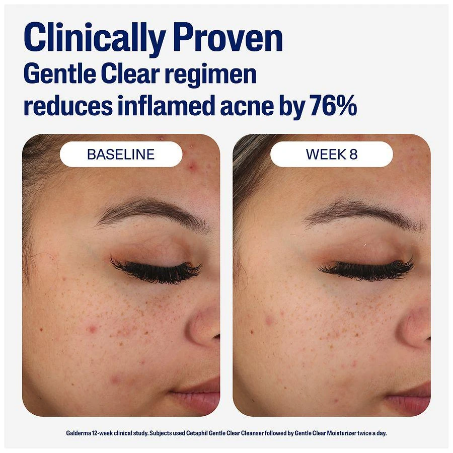 Cetaphil Gentle Clear Mattifying Acne Moisturizer 9