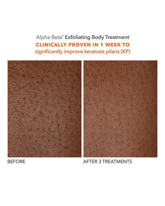 Dr. Dennis Gross Alpha Beta® Exfoliating Body Treatment 3