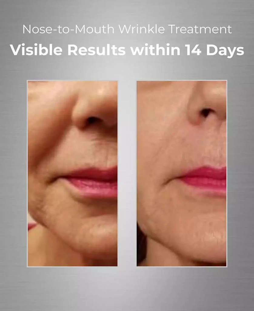 Bionova Nose-To-Mouth Wrinkle Treatment With UV Chromophores 4