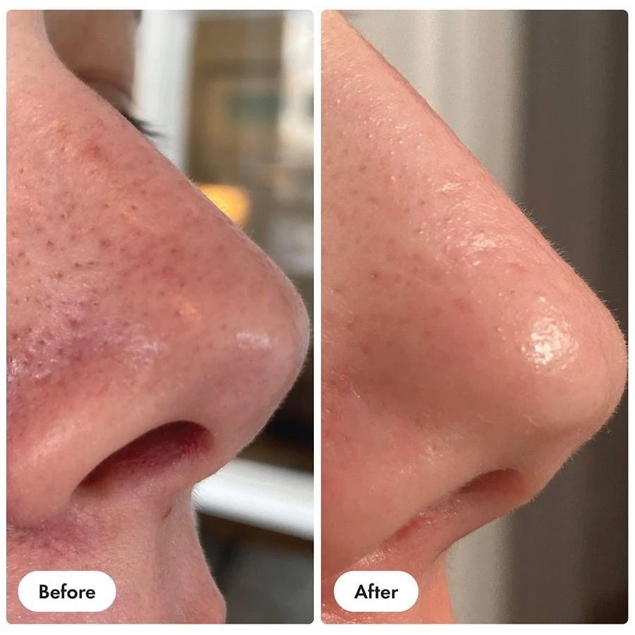 Hero Cosmetics Pore Release Blackhead Clearing Solution 5