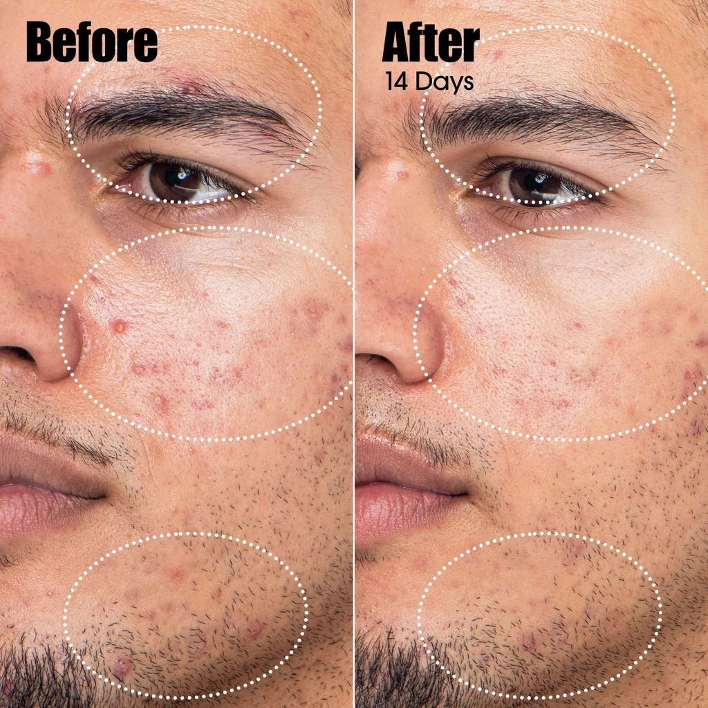 Sunday Riley Sunday Riley Peacekeeper Azaleic and Salicylic Acid Acne Treatment Serum 30ml 4