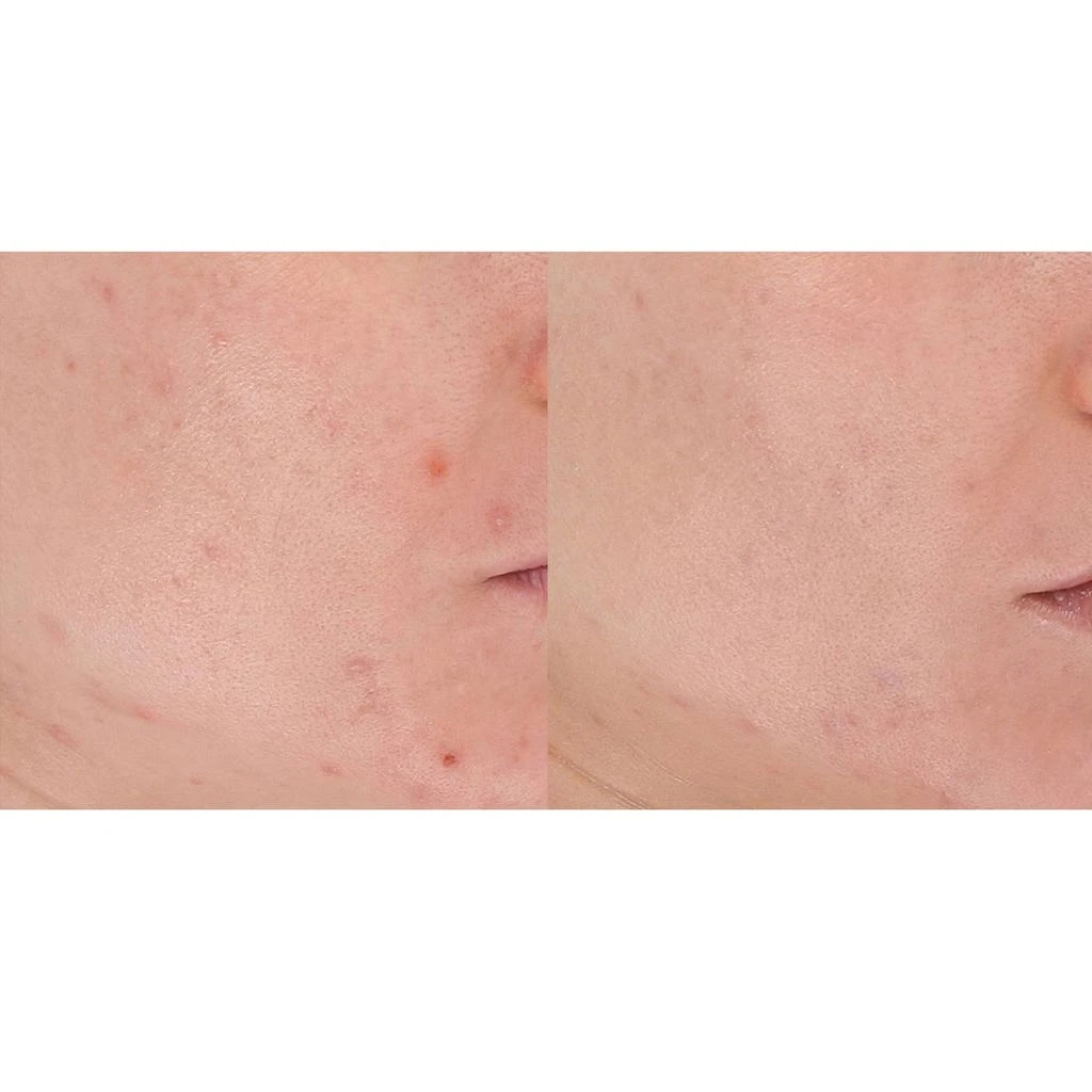LightStim LightStim for Acne 9
