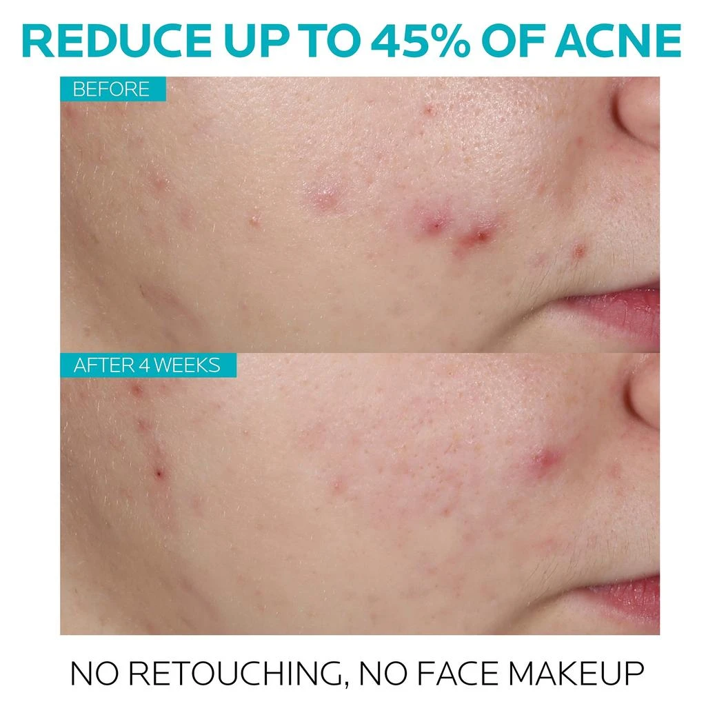 La Roche Posay La Roche-Posay Effaclar Salicylic Acid Acne Treatment Serum 5