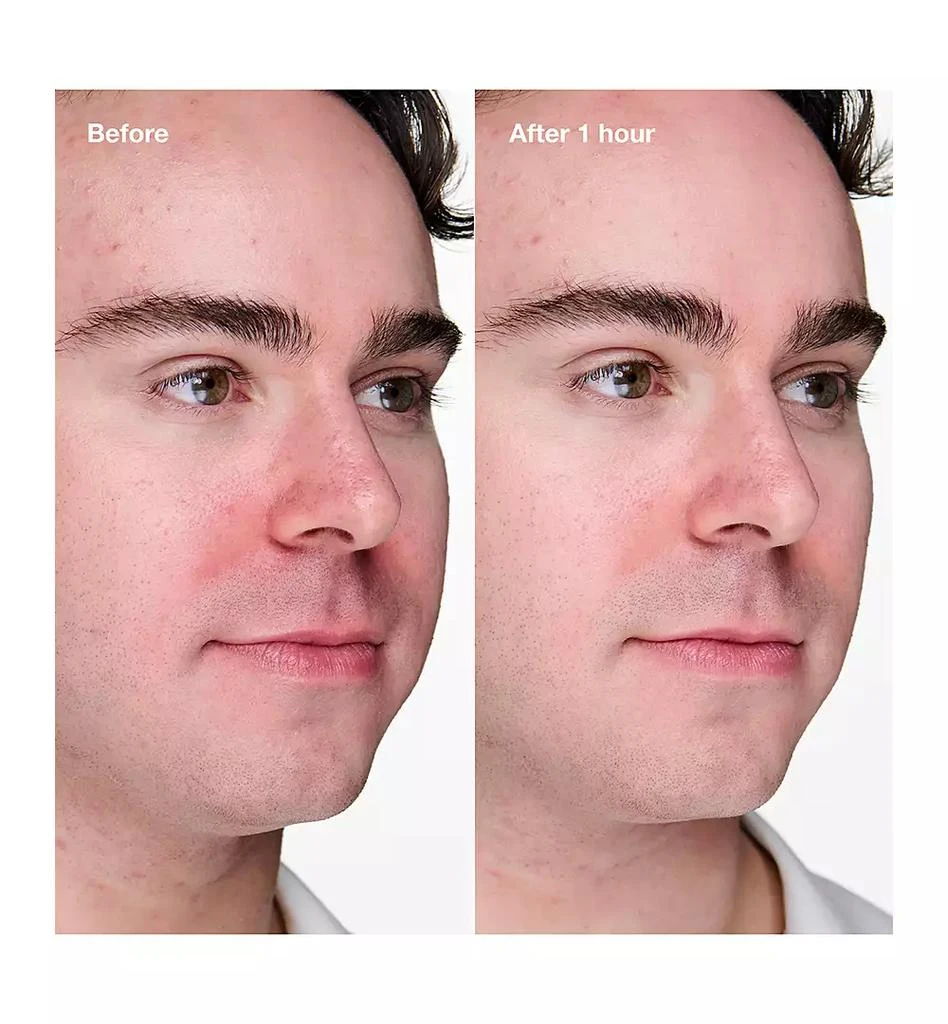 Clinique Acne Solutions Clinical Advanced Clearing Gel With Salicylic Acid 4