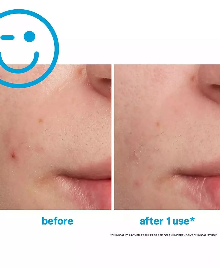 Kate Somerville EradiKate Acne Treatment, 1 oz. 5