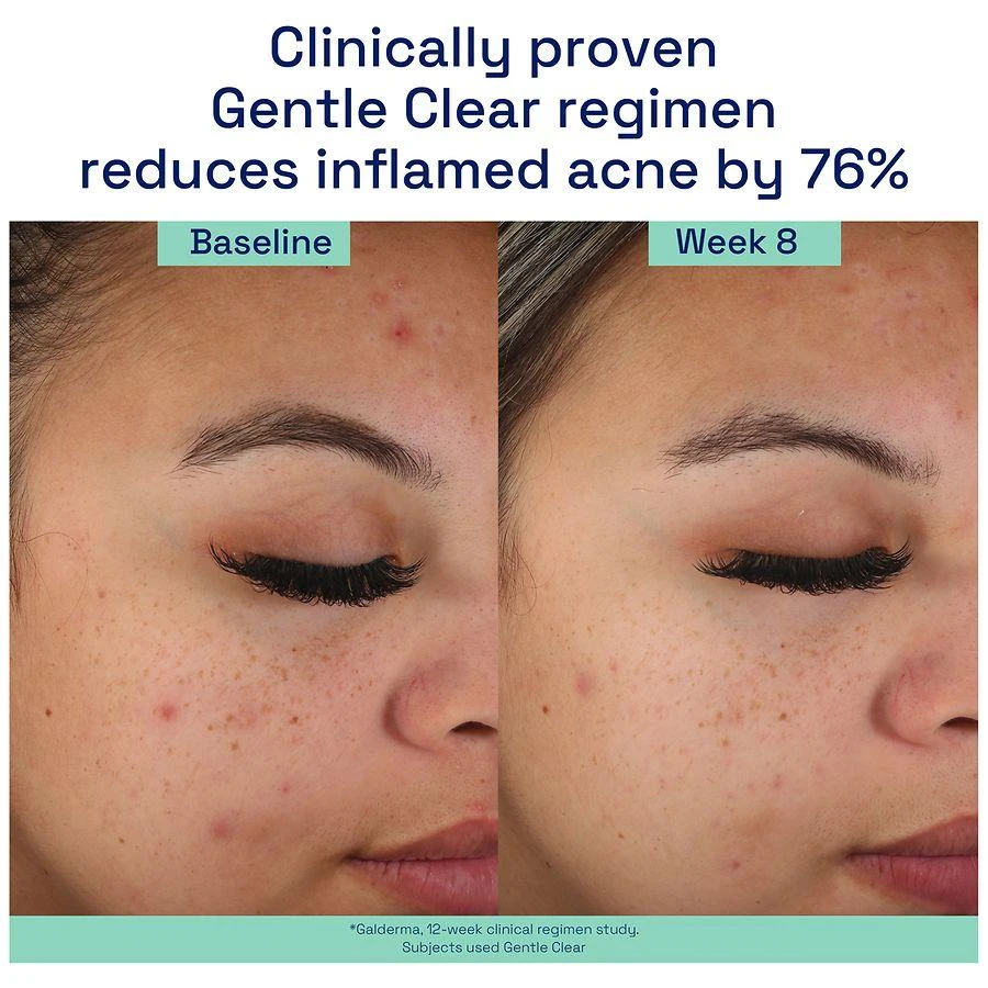 Cetaphil Gentle Clear Mattifying Acne Moisturizer 2