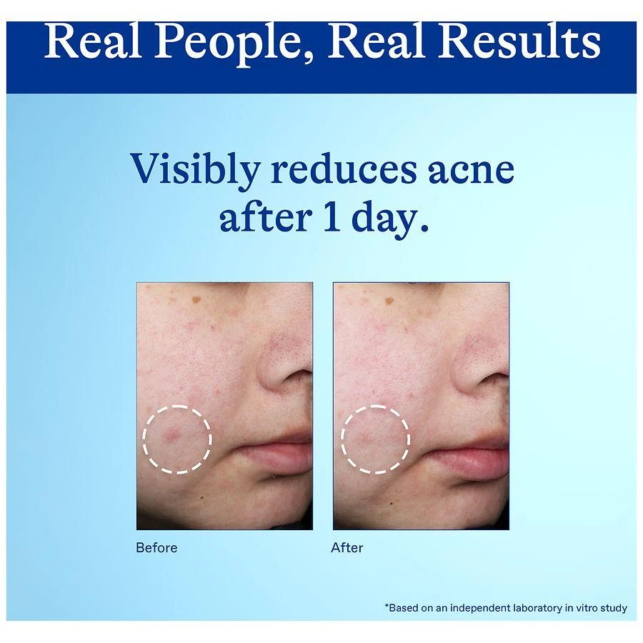 Differin Benzoyl Peroxide Spot Treatment Cream 6