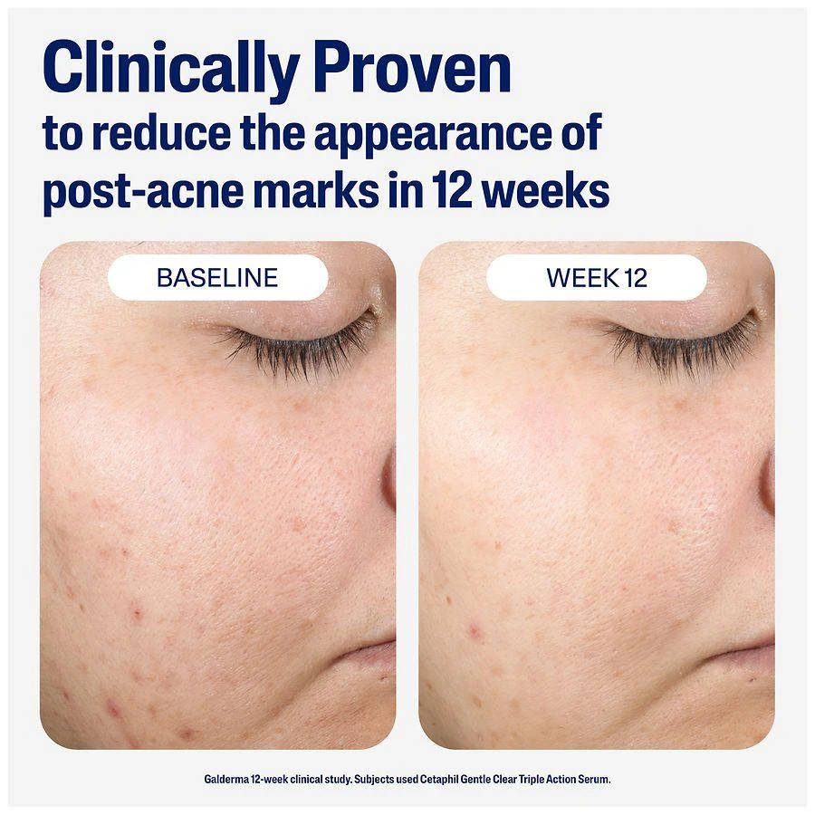 Cetaphil Gentle Clear Repairing Post Acne Serum Unscented 6