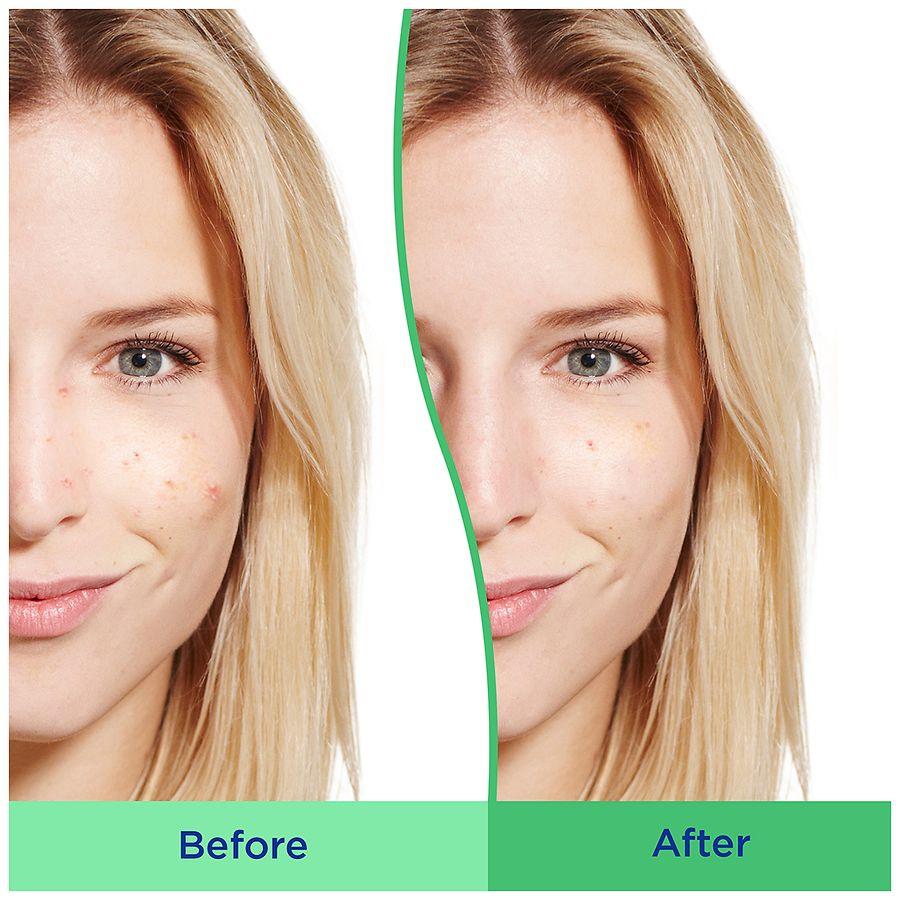 Differin Daily Deep Cleanser with Benzoyl Peroxide