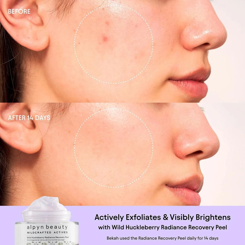 Alpyn Beauty Wild Huckleberry Radiance Recovery Peel 3