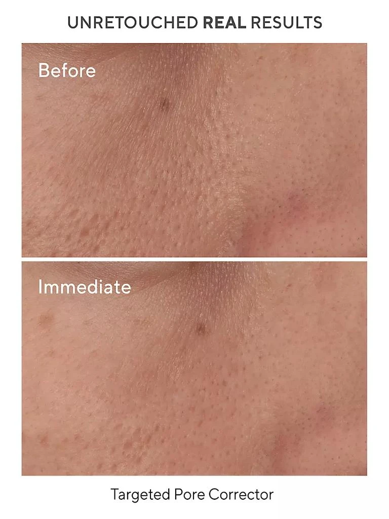 Murad Acne Control Targeted Pore Corrector 3