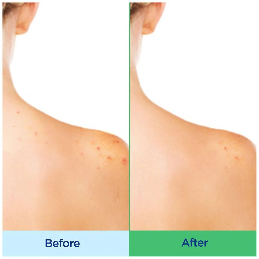 Differin Acne-Clearing Body Wash 10 oz Tube 5