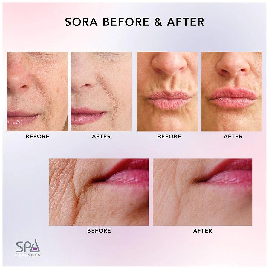 Spa Sciences Sora Microneedle Derma Pen System - USB Rechargeable 7