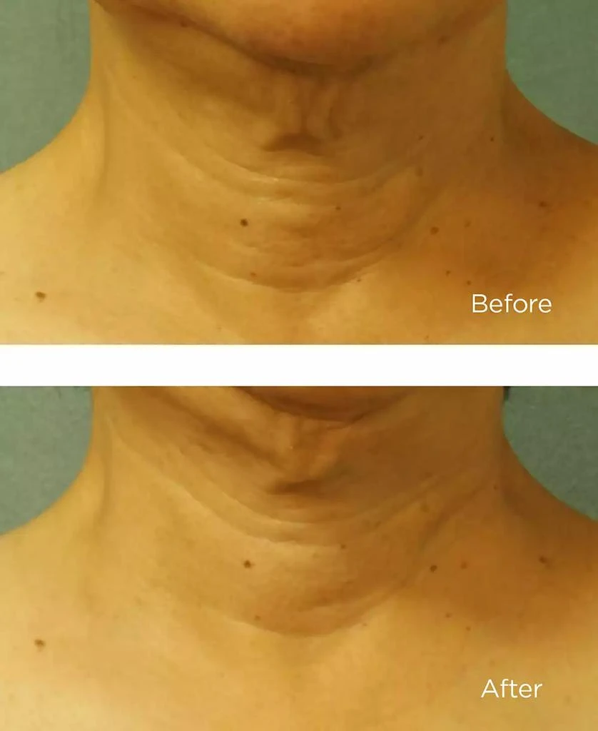 Perricone MD Cold Plasma Plus+ Neck 
Chest, 1-oz. 3