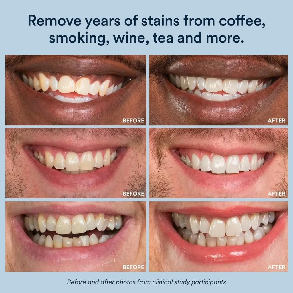 AuraGlow Auraglow Whitening Toothpaste Booster, Add to Toothpaste to Whiten, 9% Hydrogen Peroxide Teeth Whitening Gel Toothpaste, 350+ Whitening Treatments, 6-Month Supply, 2.6oz 5