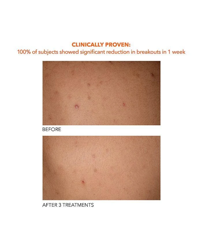 Dr. Dennis Gross Alpha Beta® Exfoliating Body Treatment 4