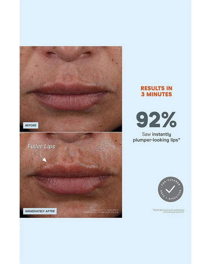 NuFace FIX + Starter Kit 5