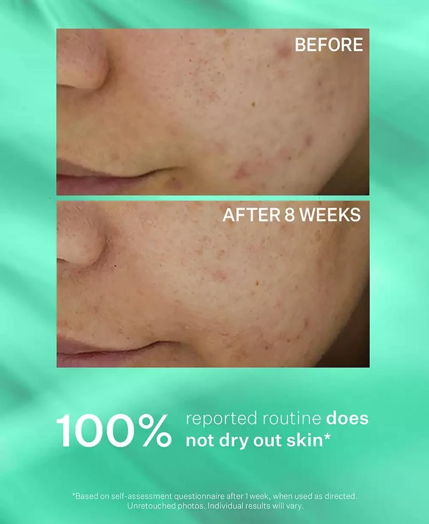 StriVectin 3-Pc. Acne Control Trial Set 6