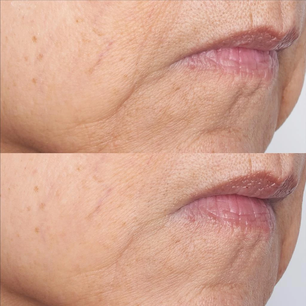 Perricone MD Cold Plasma Plus+ The Intensive Gel Mask 4