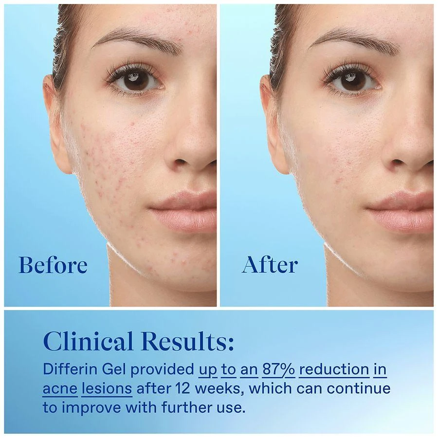 Differin Gel Acne Treatment 8