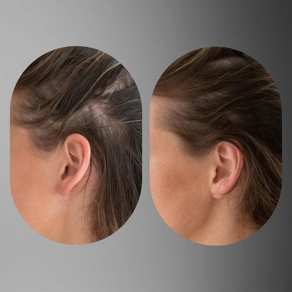 Act+Acre Act+Acre Dermaroller Hair System (Worth $132.00) 4