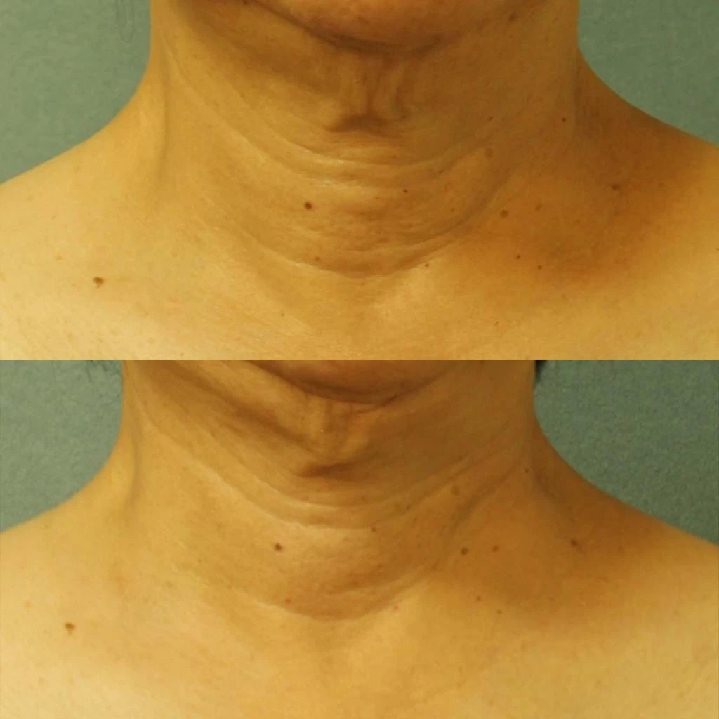 Perricone MD Perricone MD Cold Plasma Plus+ Neck & Chest Broad Spectrum SPF 25 4