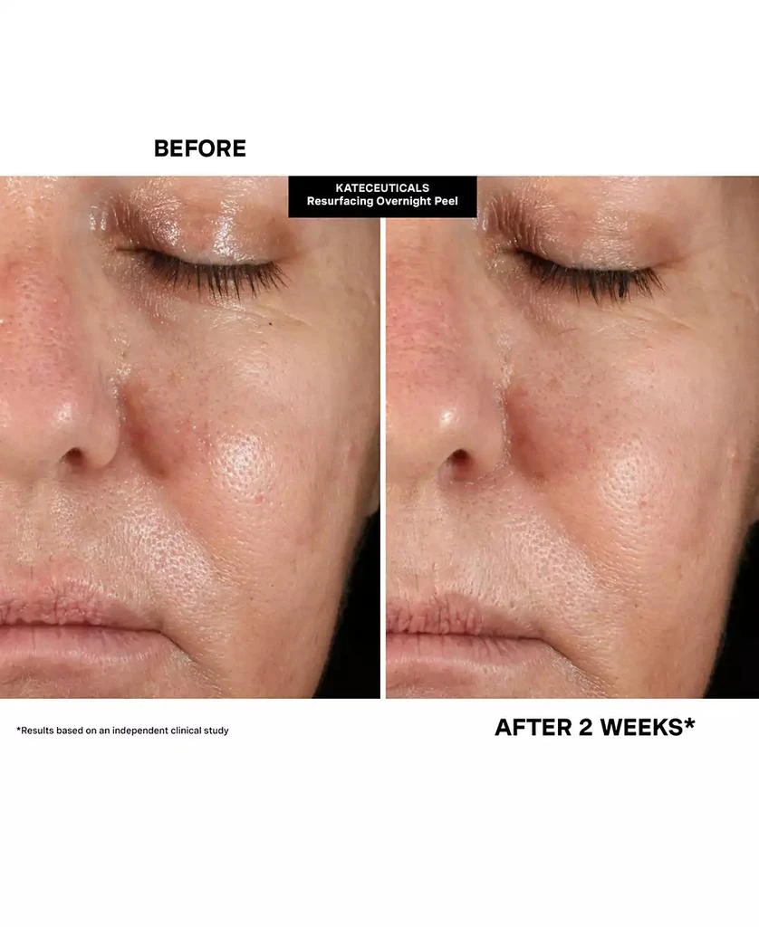 Kate Somerville KateCeuticals Resurfacing Overnight Peel, 1 oz. 13