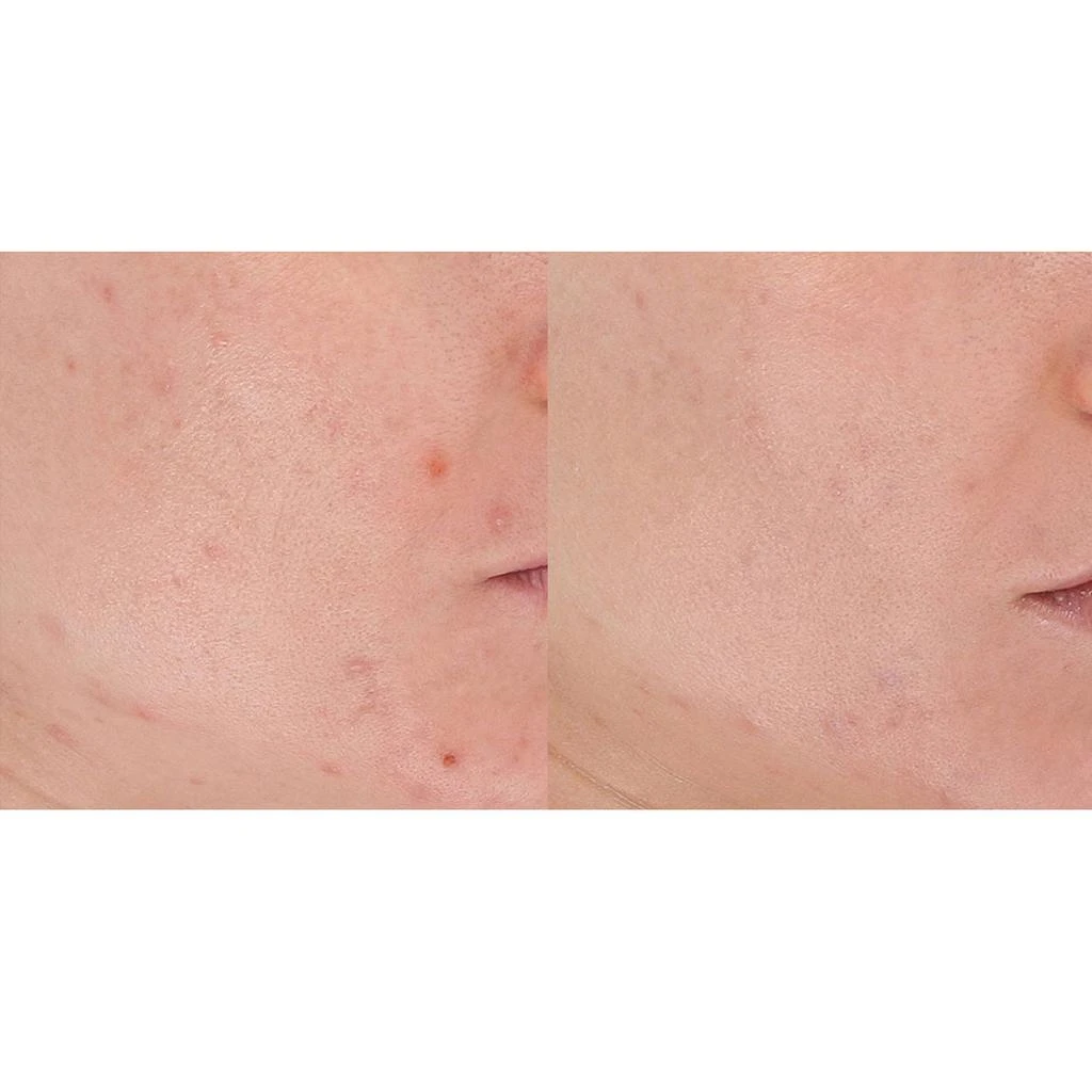 LightStim LightStim for Acne 5