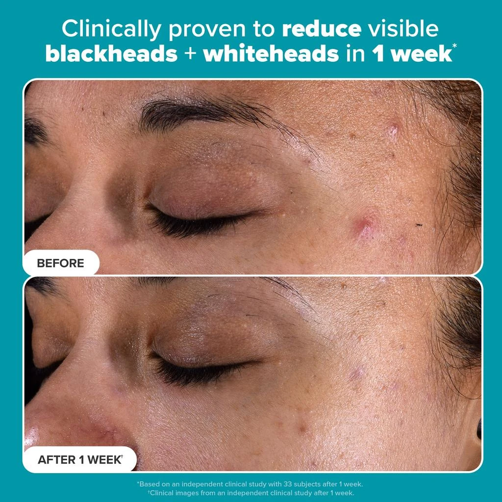 Paula
s Choice Paula
s Choice 2% BHA Exfoliating Toner Pads 3