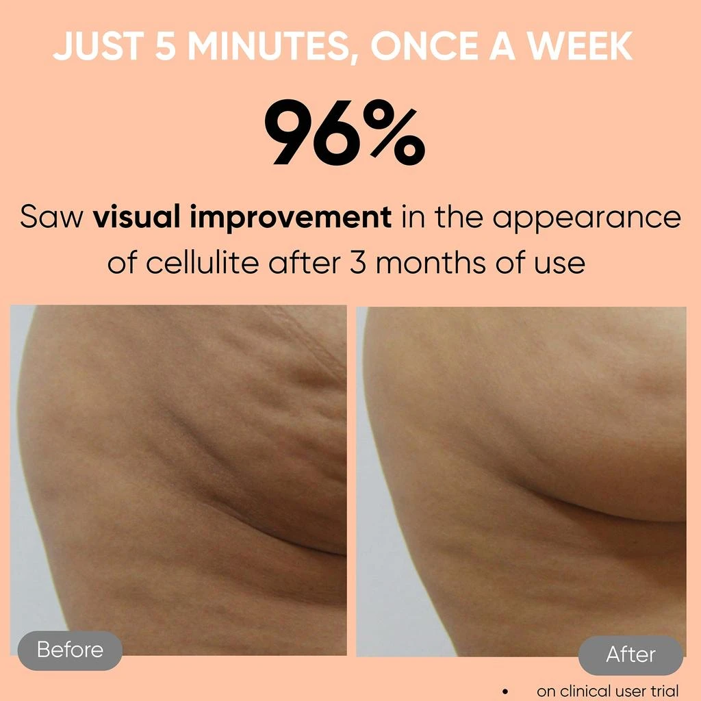 Sensica Sensica Sensifirm RF for Cellulite 4