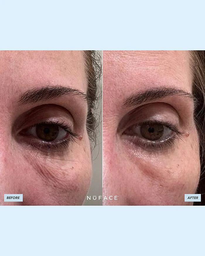 NuFace Trinity All In One Kit ($785 value) 10