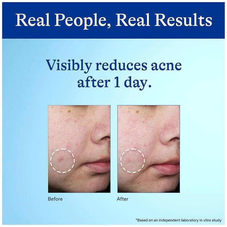 Differin 10% Benzoyl Peroxide Spot Treatment 5