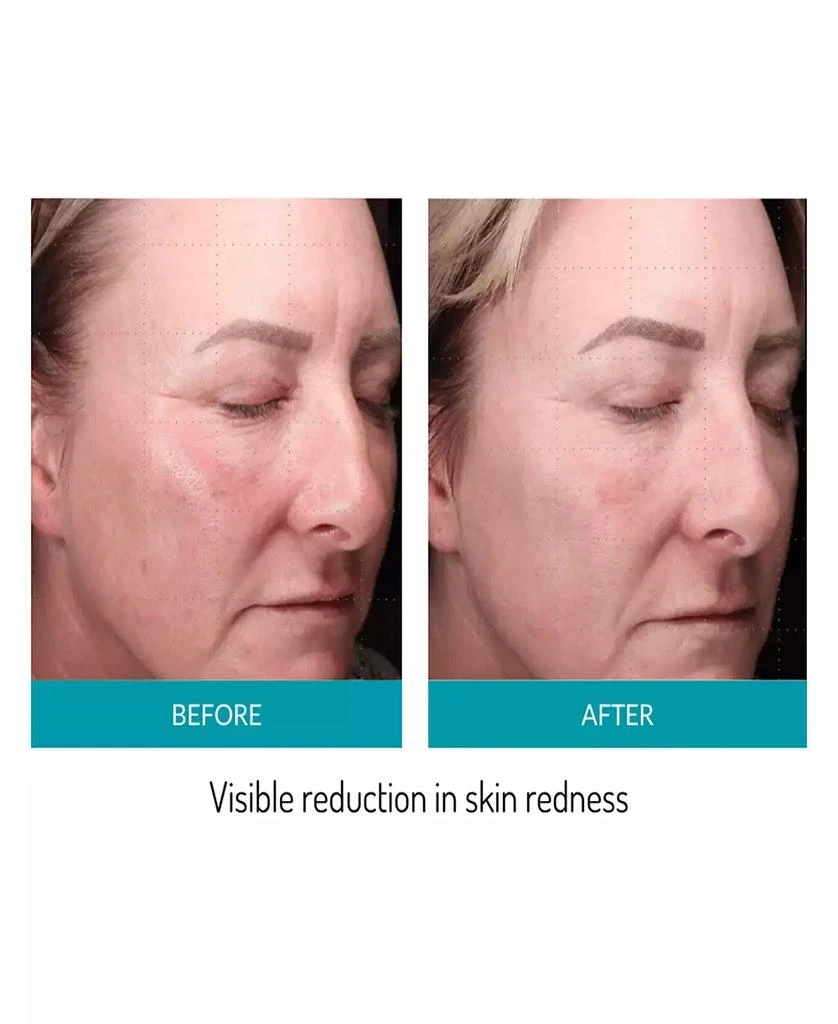 glo Mask LED Phototherapy Mask 9