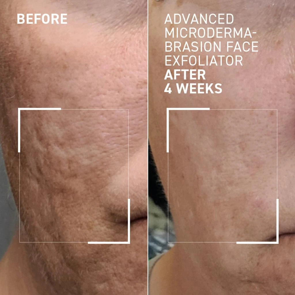 Dr. Brandt Skincare Advanced Face Exfoliator 3