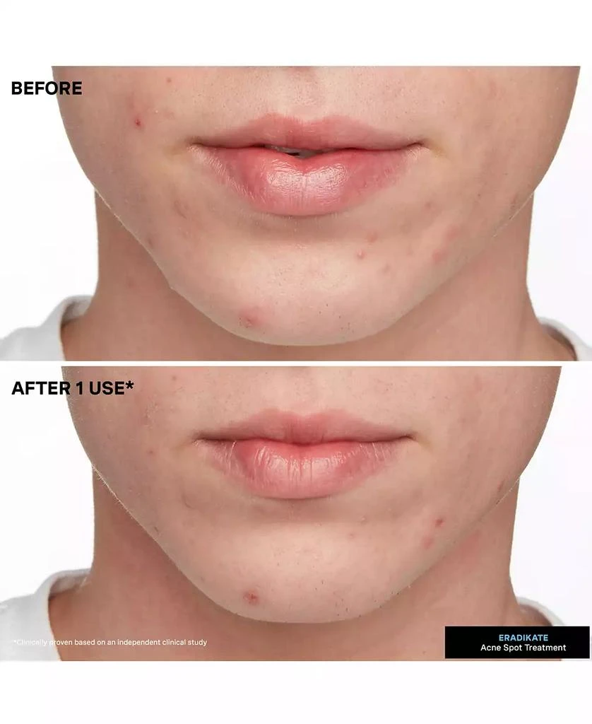 Kate Somerville EradiKate Acne Treatment, 1 oz. 7