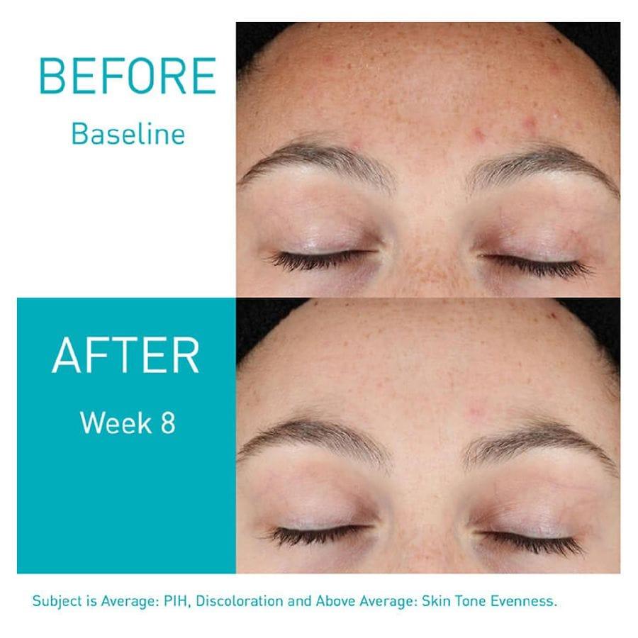 CeraVe Retinol Serum for Post-Acne Marks and Skin Texture
