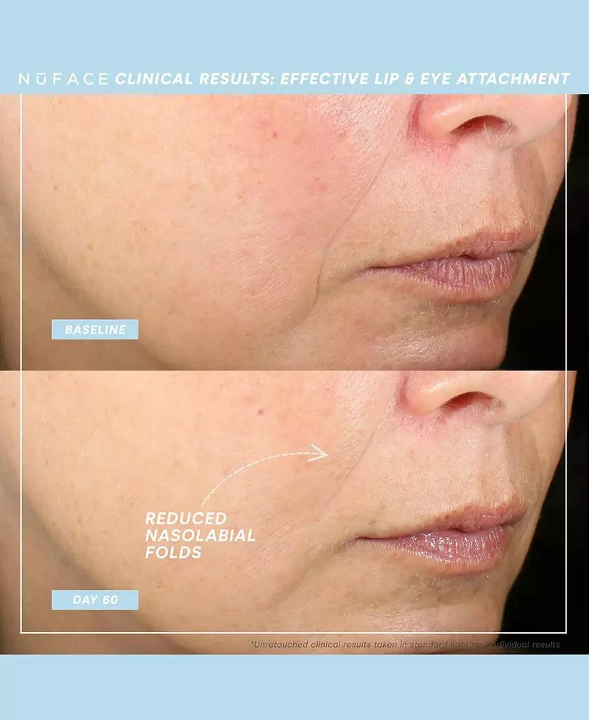 NuFace Effective Lip & Eye Attachment 2