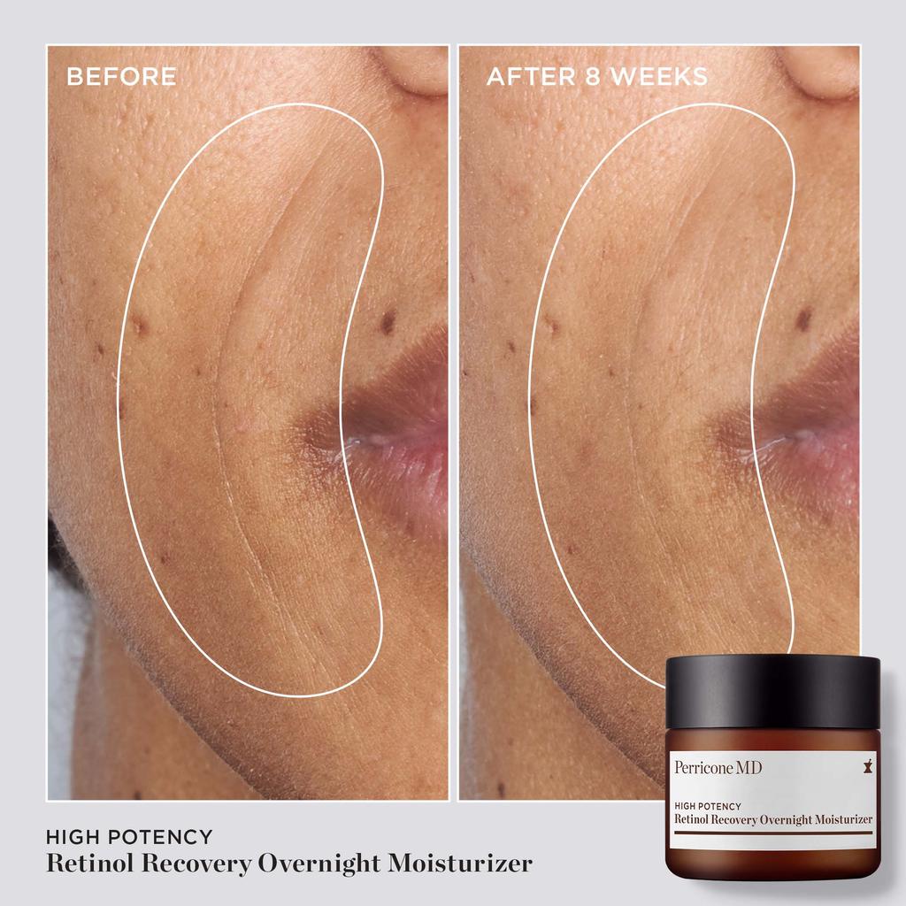 Perricone MD High Potency Retinol Recovery Overnight Moisturizer