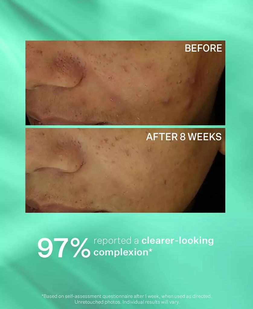 StriVectin 3-Pc. Acne Control Trial Set 7