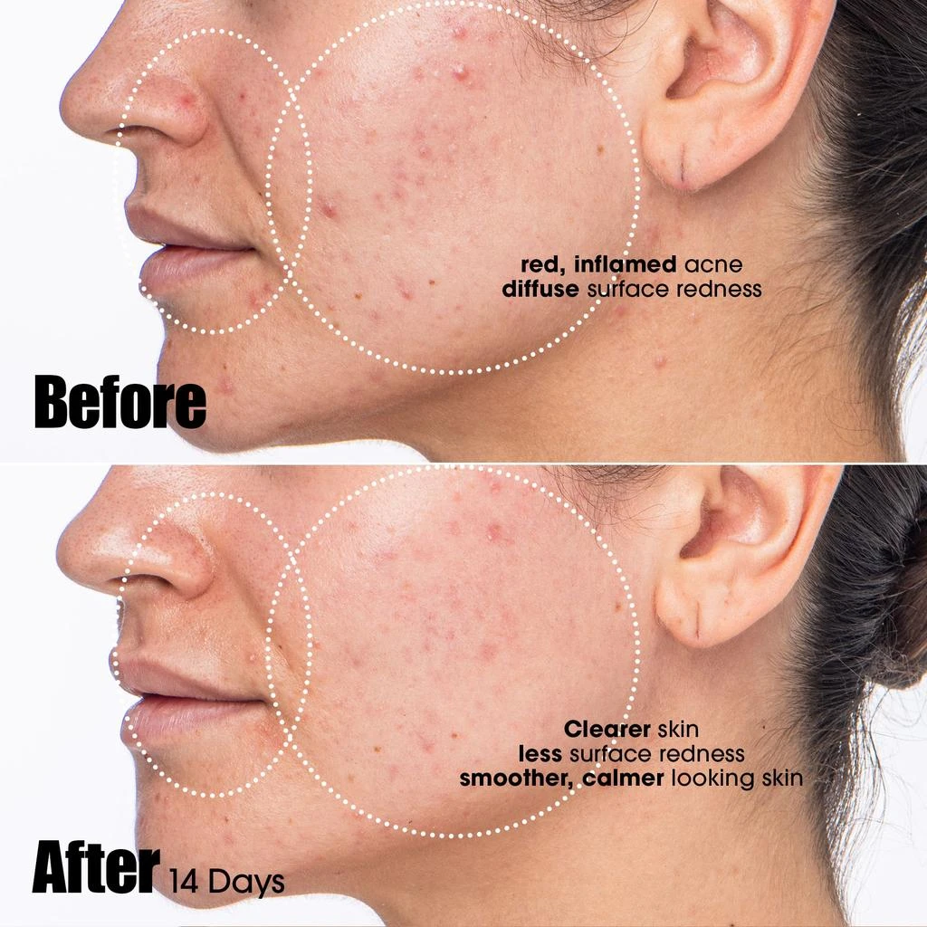 Sunday Riley Sunday Riley Peacekeeper Azaleic and Salicylic Acid Acne Treatment Serum 30ml 3