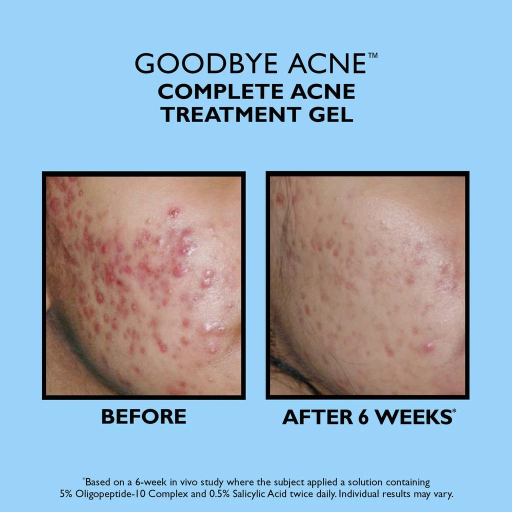 Peter Thomas Roth Goodbye Acne Complete Acne Treatment Gel|50 ml / 1.7 fl oz 2