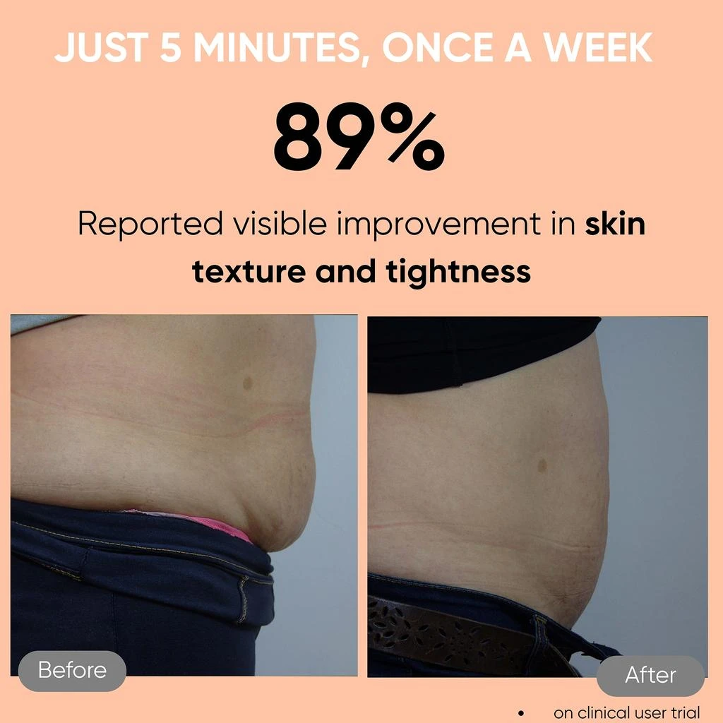 Sensica Sensica Sensifirm RF for Cellulite 5