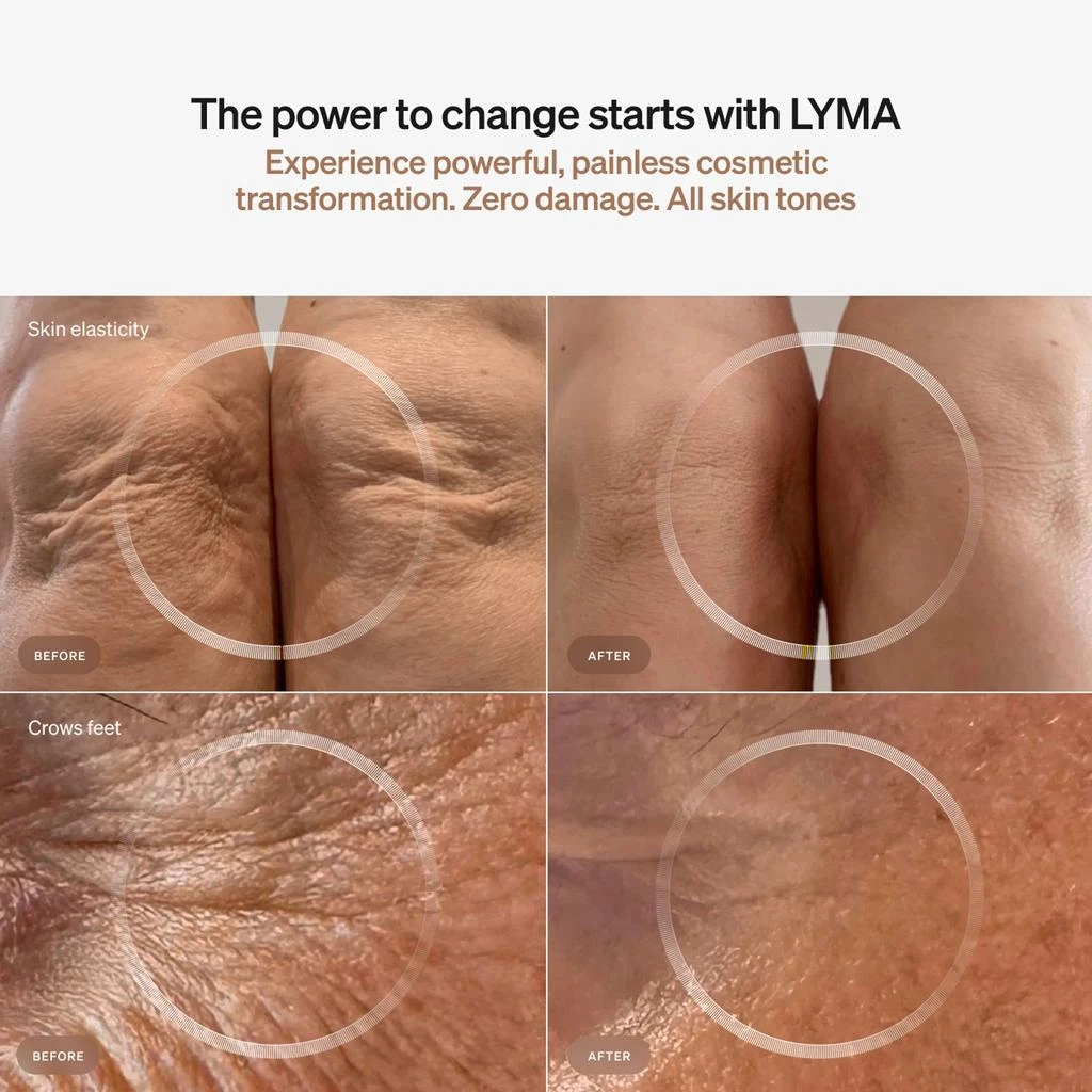 LYMA LYMA Laser Starter Kit 3