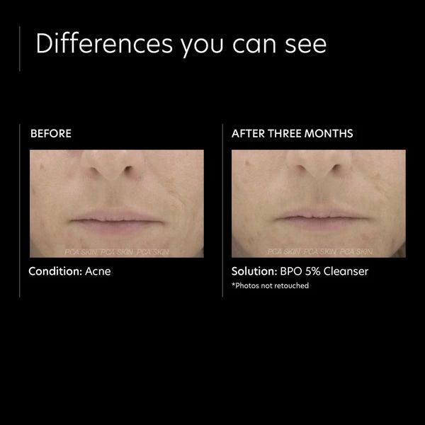 PCA SKIN PCA SKIN BPO 5 Percent Cleanser 4