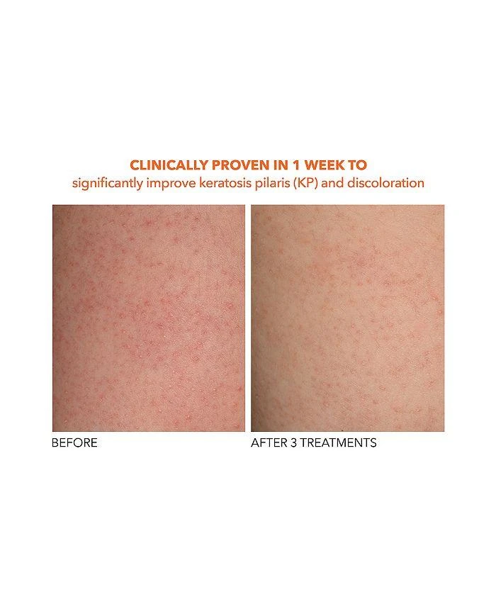 Dr. Dennis Gross Alpha Beta® Exfoliating Body Treatment 2