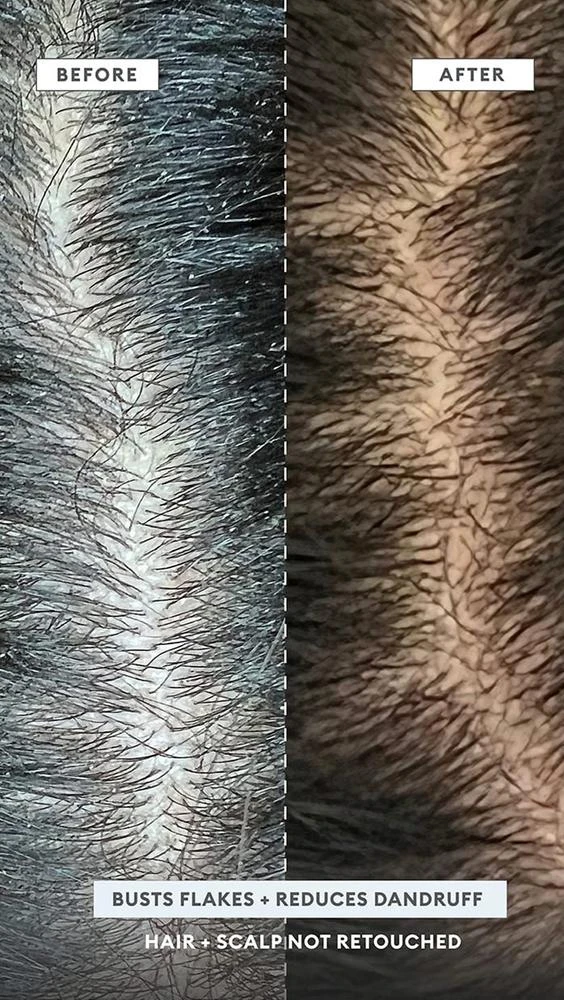 Briogeo MegaStrength + Dandruff Relief Shampoo 3