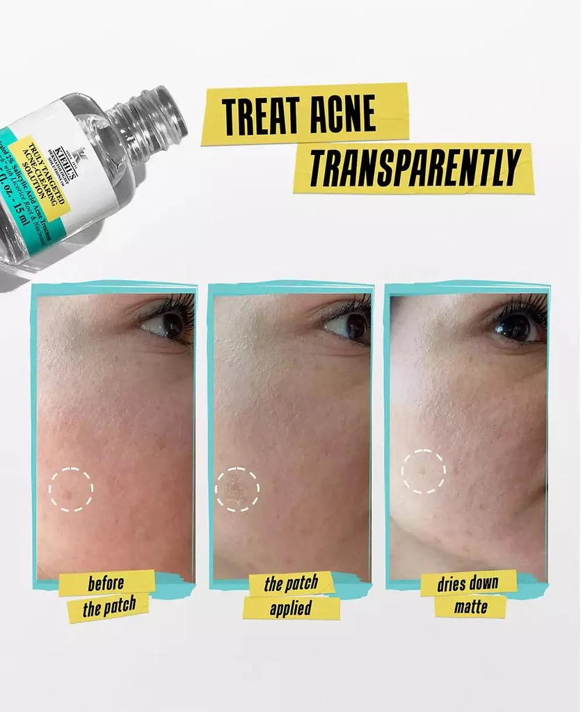 Kiehl's Truly Targeted Acne-Clearing Solution 5
