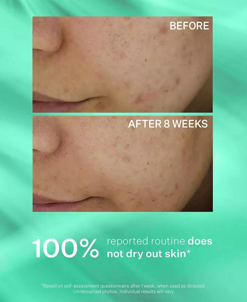 StriVectin 3-Pc. Acne Control Trial Set 6