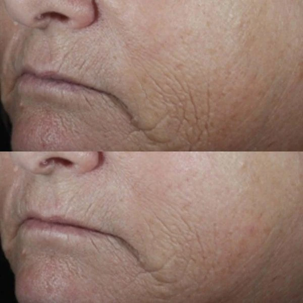 Perricone MD Perricone MD Neuropeptide Smoothing Facial Conformer 3